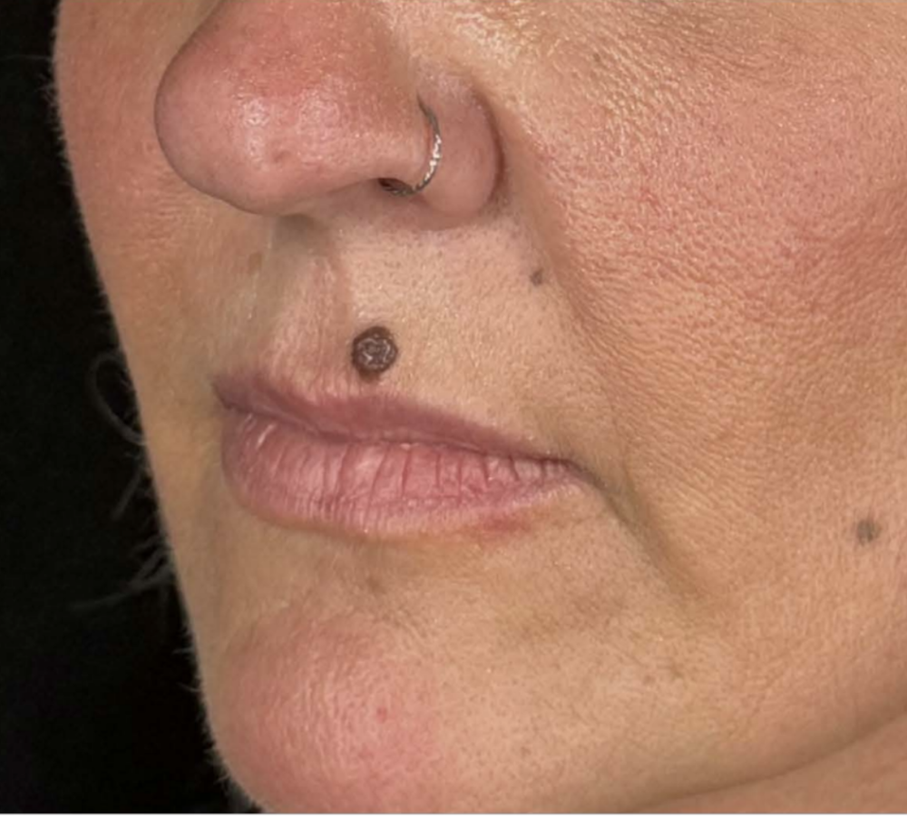 Skin Lesion Biopsy and Excision