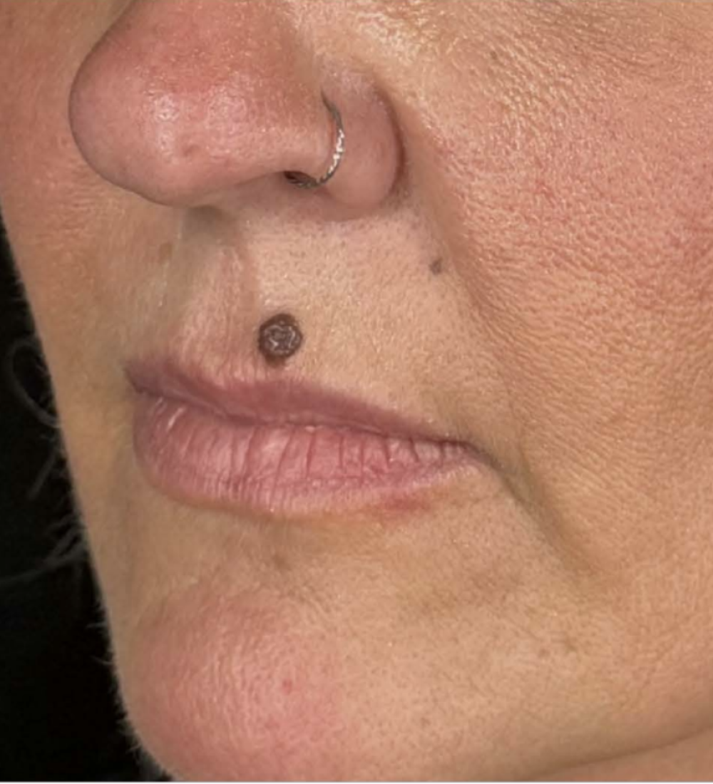 Skin Lesion Biopsy and Excision