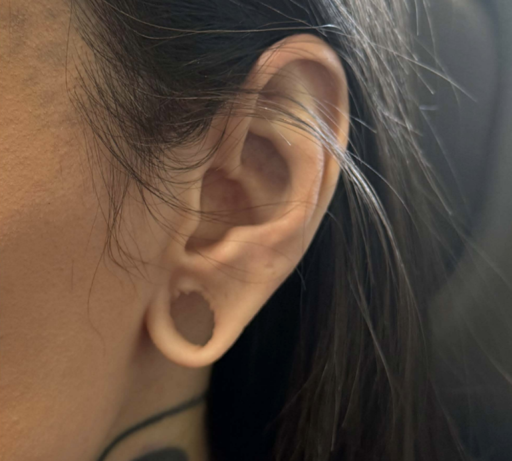 Ear Lobe Repair